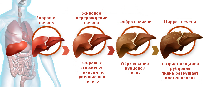 Цирроз печени